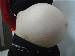 双子,妊娠,出産,育児,体験お腹に妊娠線　双子の腹囲